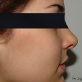 Rinoplastia